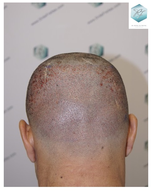 CLINICA DE FREITAS - 2077 GRAFTS FUE 23_zps5dnmsmc1