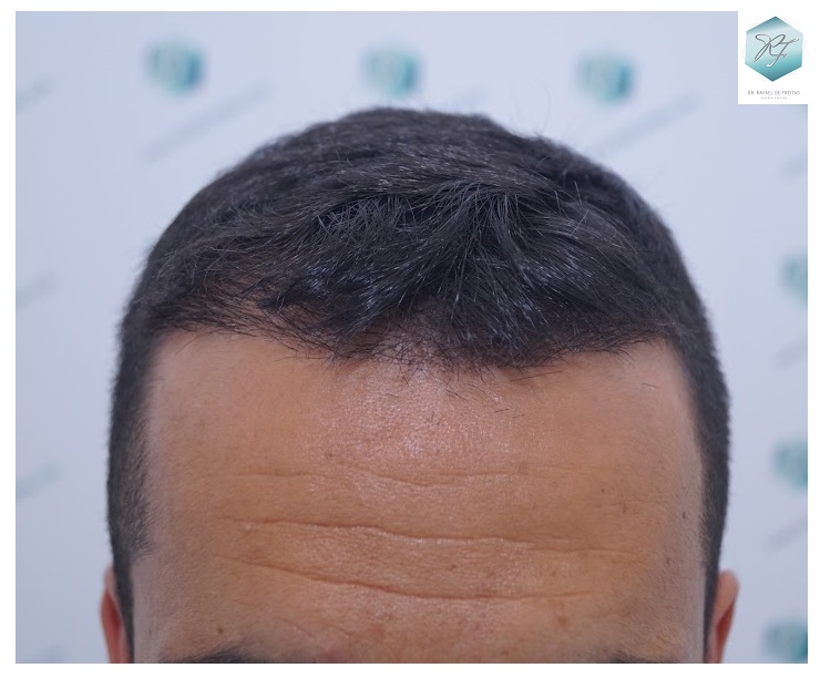 CLINICA DE FREITAS - 2077 GRAFTS FUE 24_zpsdfjcjl01