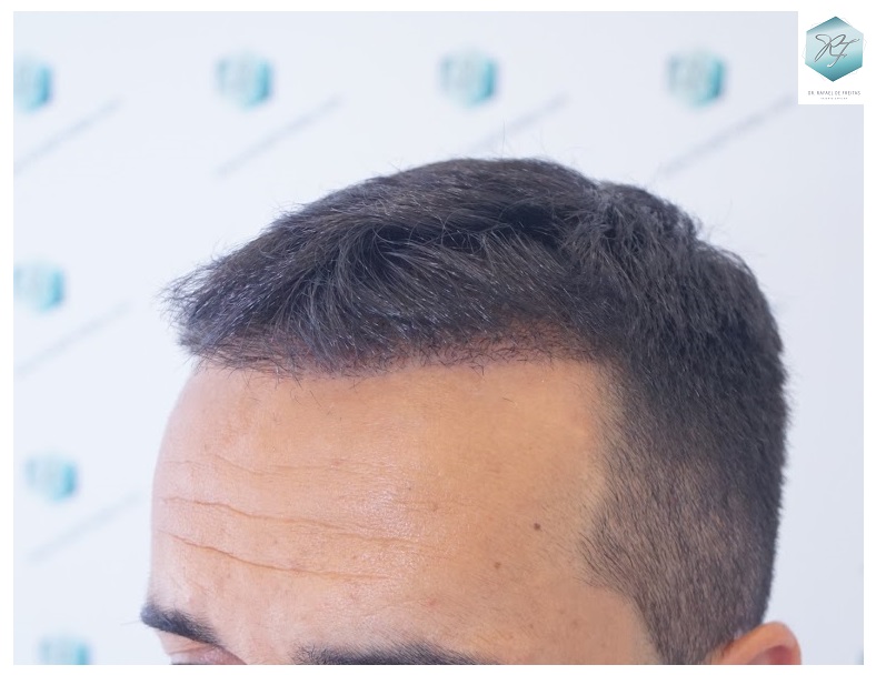 CLINICA DE FREITAS - 2077 GRAFTS FUE 25_zpsf90nkonx