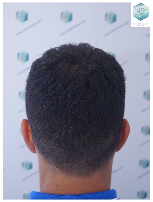 CLINICA DE FREITAS - 2077 GRAFTS FUE 30_zpsmswkwpau