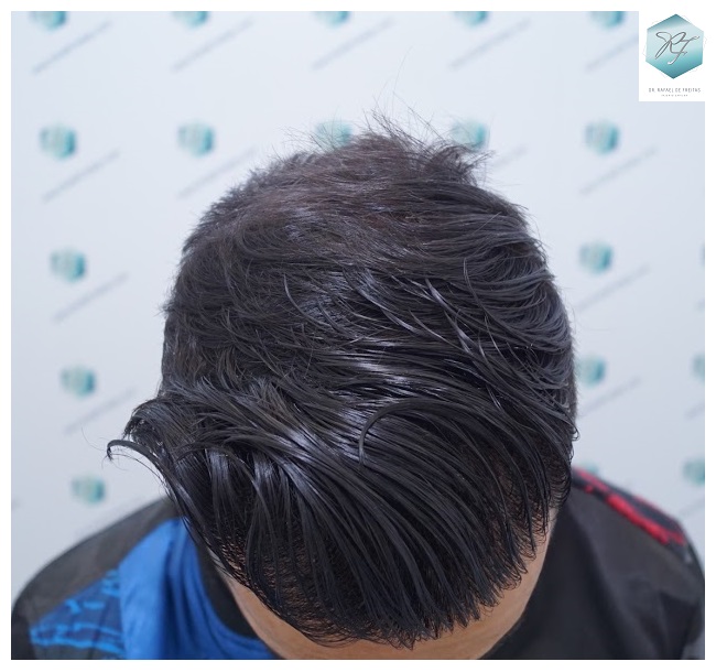 CLINICA DE FREITAS - 2077 GRAFTS FUE 38_zpsrfgwk3rl