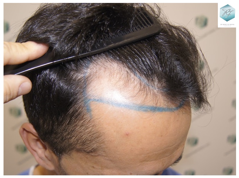 CLINICA DE FREITAS - 2077 GRAFTS FUE 3_zpswzxgjpl9