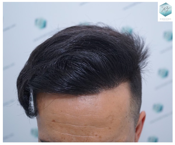 CLINICA DE FREITAS - 2077 GRAFTS FUE 52_zpstrmj48gm