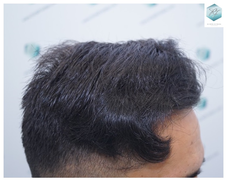 CLINICA DE FREITAS - 2077 GRAFTS FUE 53_zps6hnbptfn