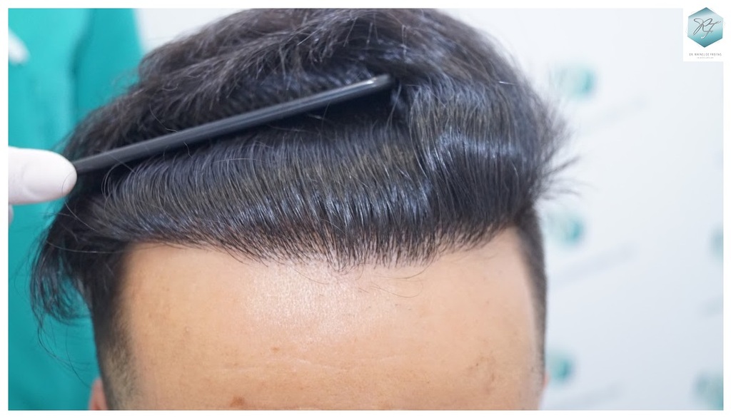 CLINICA DE FREITAS - 2077 GRAFTS FUE 54_zpsczvp3j45