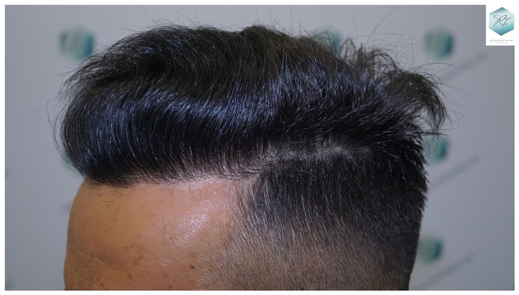 CLINICA DE FREITAS - 2077 GRAFTS FUE 56_zpsu8pj800o