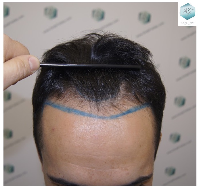 CLINICA DE FREITAS - 2077 GRAFTS FUE 5_zpspwktymdv