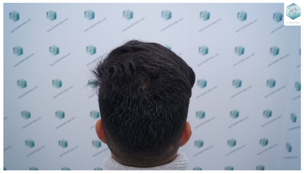 CLINICA DE FREITAS - 2077 GRAFTS FUE 60_zpsyp7y4ssc