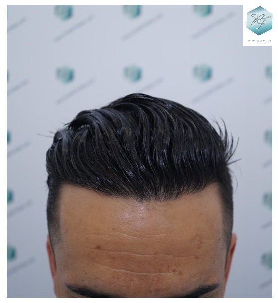 CLINICA DE FREITAS - 2077 GRAFTS FUE 61_zpsslg8qgr7