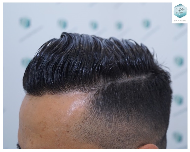 CLINICA DE FREITAS - 2077 GRAFTS FUE 63_zps0zc3cqqg