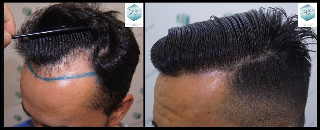 CLINICA DE FREITAS - 2077 GRAFTS FUE 69_zpsegwcbtr6