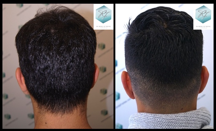 CLINICA DE FREITAS - 2077 GRAFTS FUE 71_zpsee7ygk5x