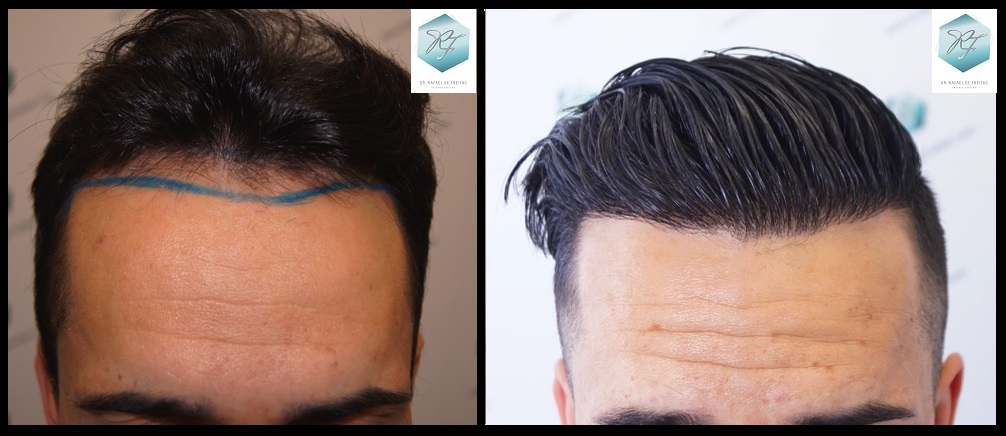 CLINICA DE FREITAS - 2077 GRAFTS FUE 72_zpssvqovifi