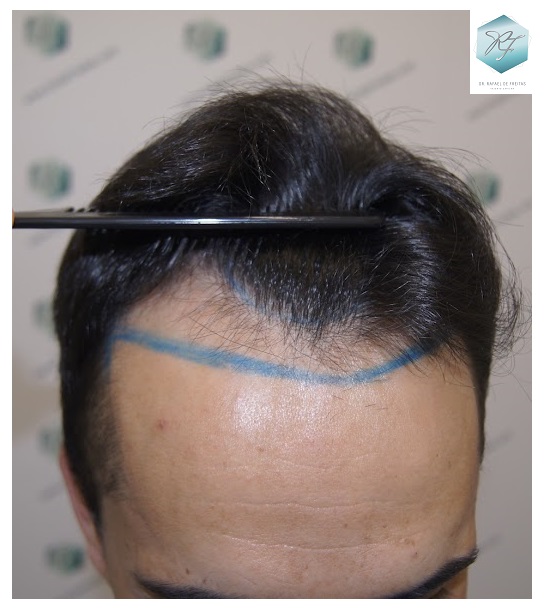 CLINICA DE FREITAS - 2077 GRAFTS FUE 7_zpssiagd9a6