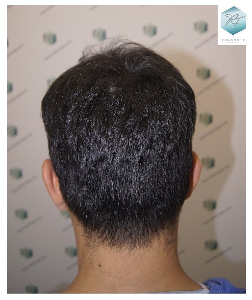 CLINICA DE FREITAS - 2077 GRAFTS FUE 9_zpsfkvz7sii