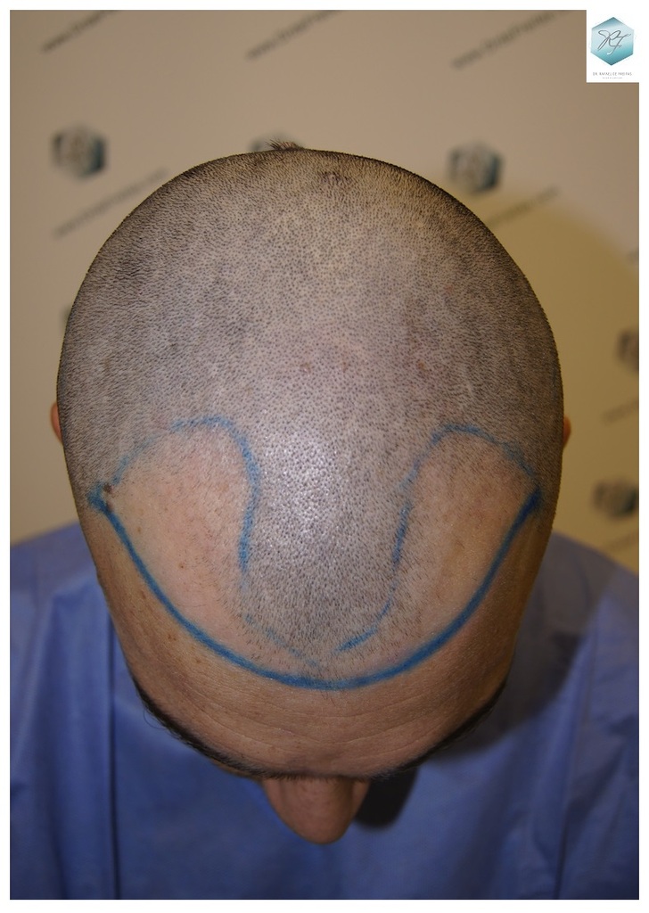 CLINICA DE FREITAS - 2094 GRAFTS FUE 11_zpsngo3alqd