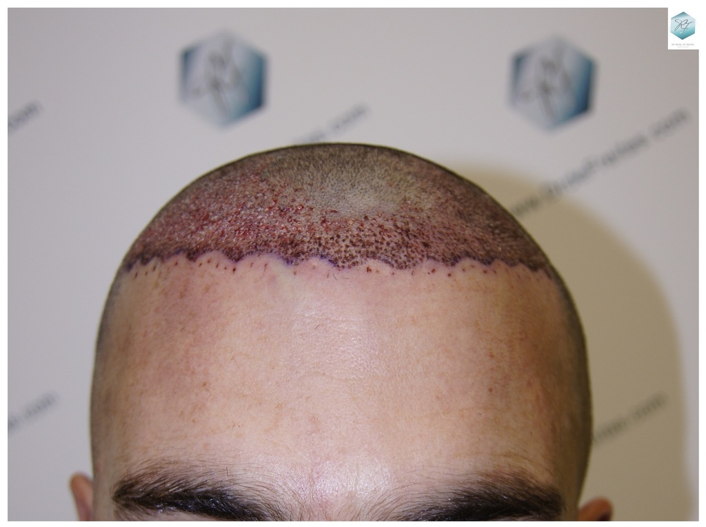 CLINICA DE FREITAS - 2094 GRAFTS FUE 15_zpsr8jif2d8