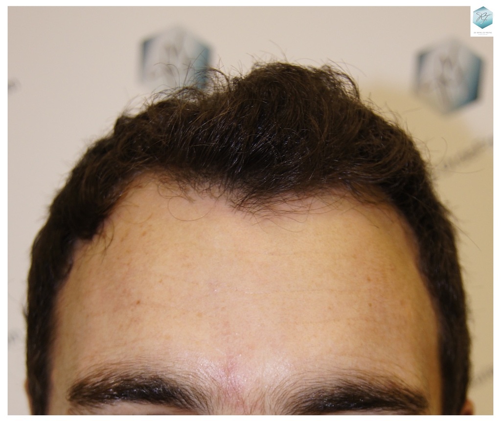 CLINICA DE FREITAS - 2094 GRAFTS FUE 1_zpsqd2xxl46