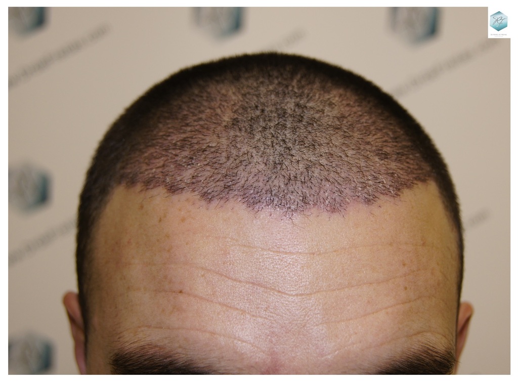 CLINICA DE FREITAS - 2094 GRAFTS FUE 21_zpskevx4hch