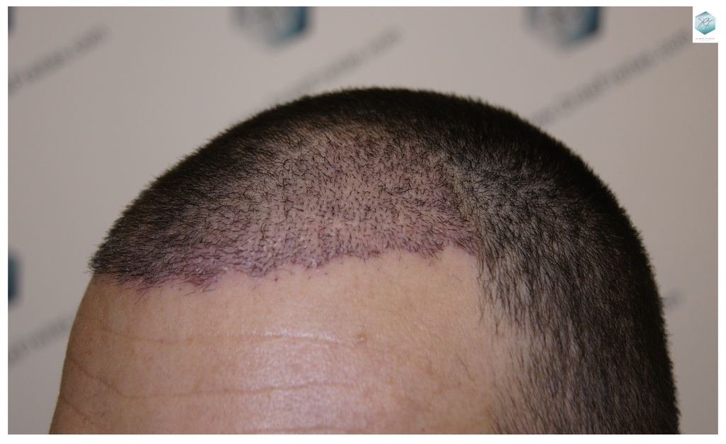 CLINICA DE FREITAS - 2094 GRAFTS FUE 22_zpsd8dwmhlp