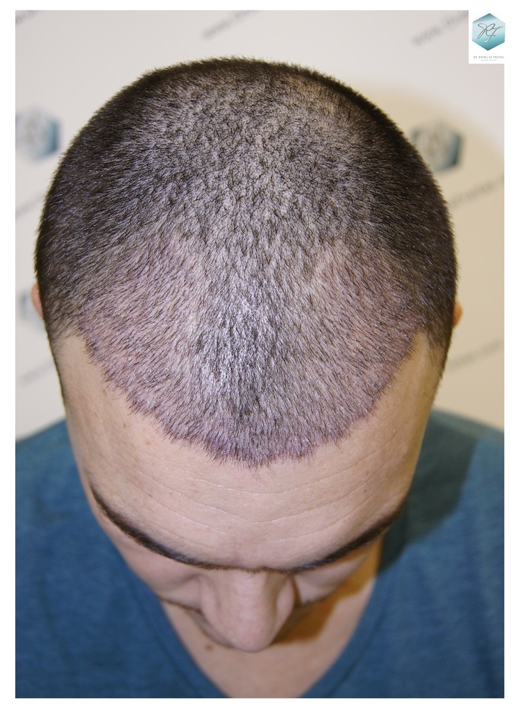 CLINICA DE FREITAS - 2094 GRAFTS FUE 23_zpsj5bjgzhw