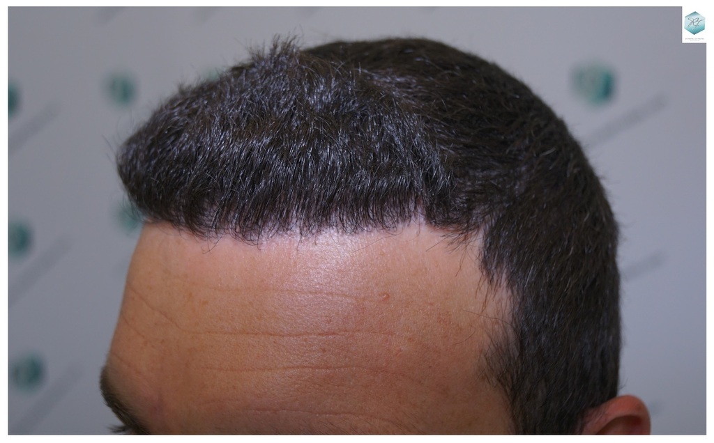 CLINICA DE FREITAS - 2094 GRAFTS FUE 29_zpsjkfytbv9