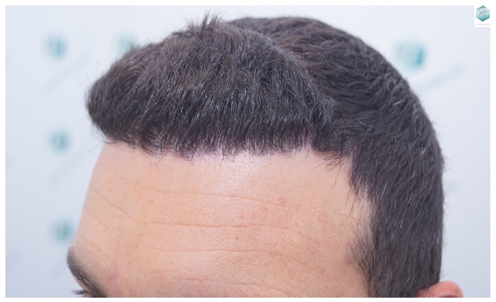 CLINICA DE FREITAS - 2094 GRAFTS FUE 30_zpsb7akmzkg