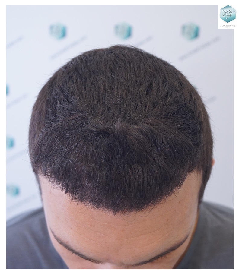 CLINICA DE FREITAS - 2094 GRAFTS FUE 32_zpsq8zo7nyo