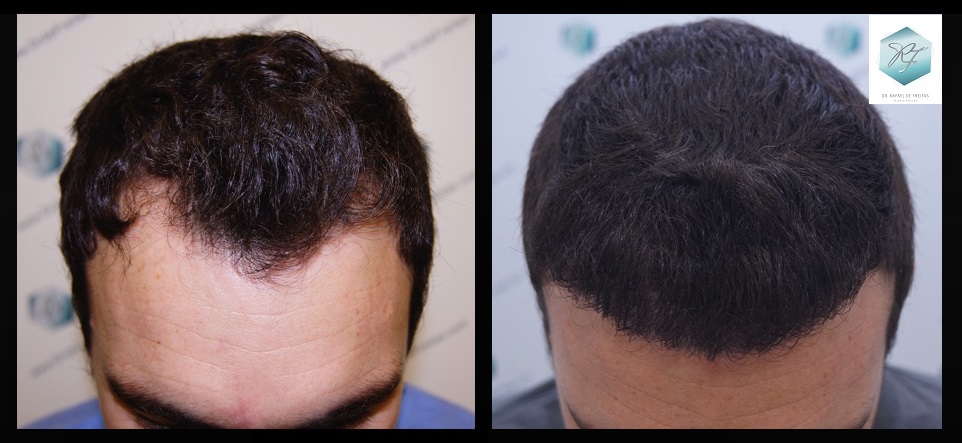 CLINICA DE FREITAS - 2094 GRAFTS FUE 37_zpss11cyjad