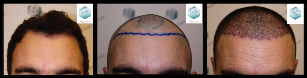 CLINICA DE FREITAS - 2094 GRAFTS FUE 38_zpsaweqmhlw