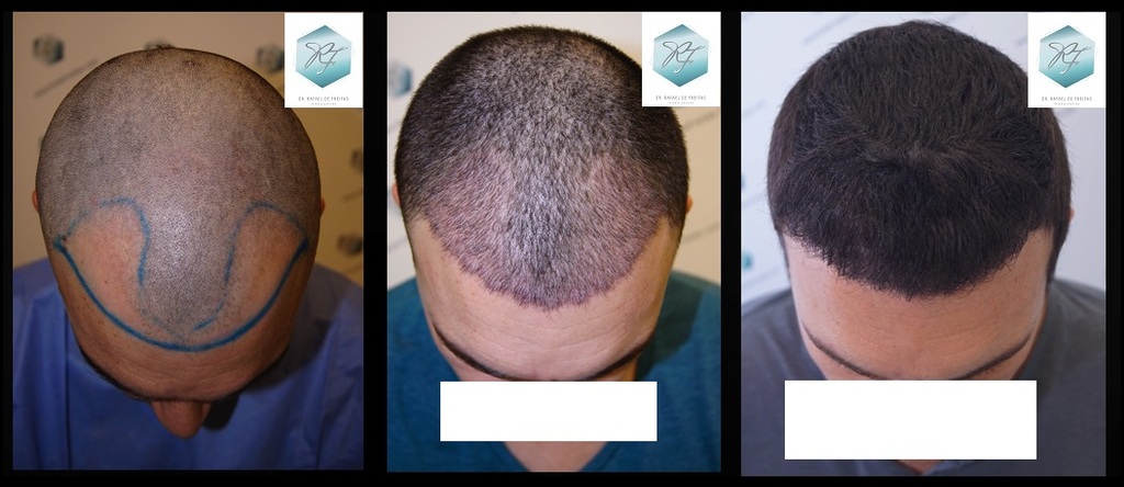 CLINICA DE FREITAS - 2094 GRAFTS FUE 39_zpscungde0s