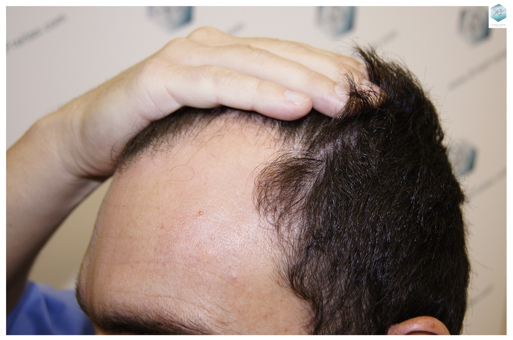 CLINICA DE FREITAS - 2094 GRAFTS FUE 3_zpslrji9tdi