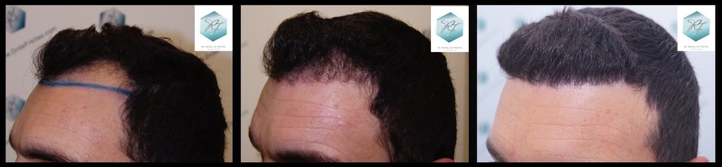 CLINICA DE FREITAS - 2094 GRAFTS FUE 40_zpsnyodew4u