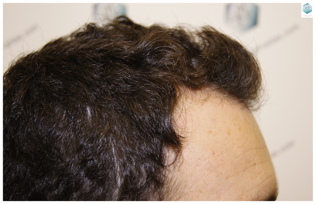 CLINICA DE FREITAS - 2094 GRAFTS FUE 4_zpstrbfnauf