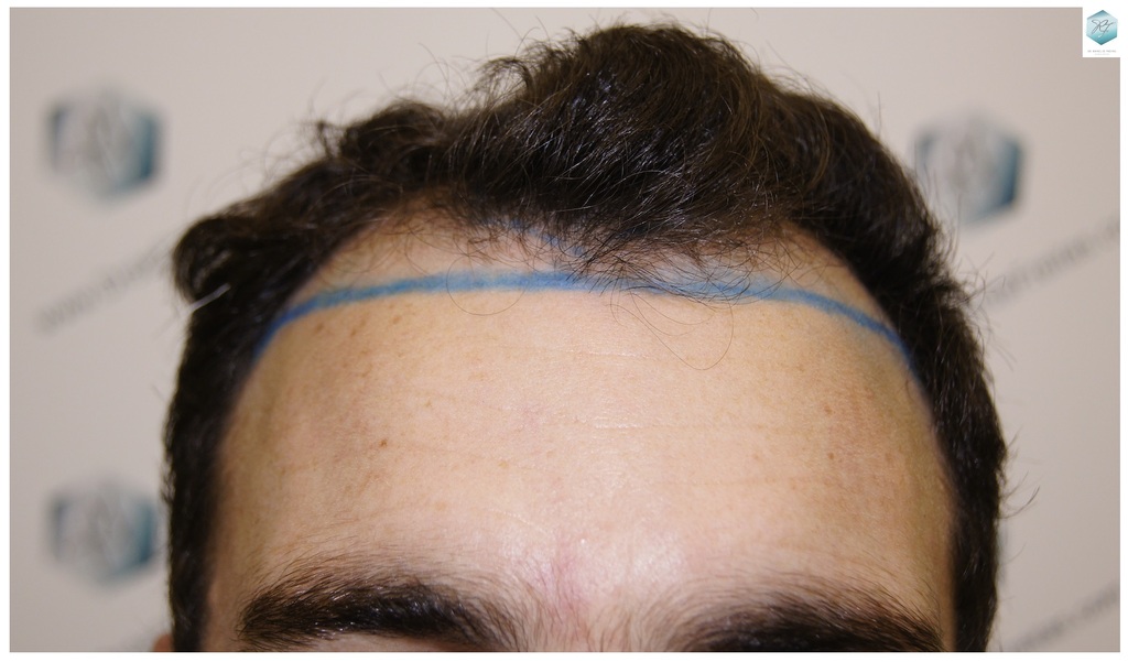 CLINICA DE FREITAS - 2094 GRAFTS FUE 7_zpsgahizmw1