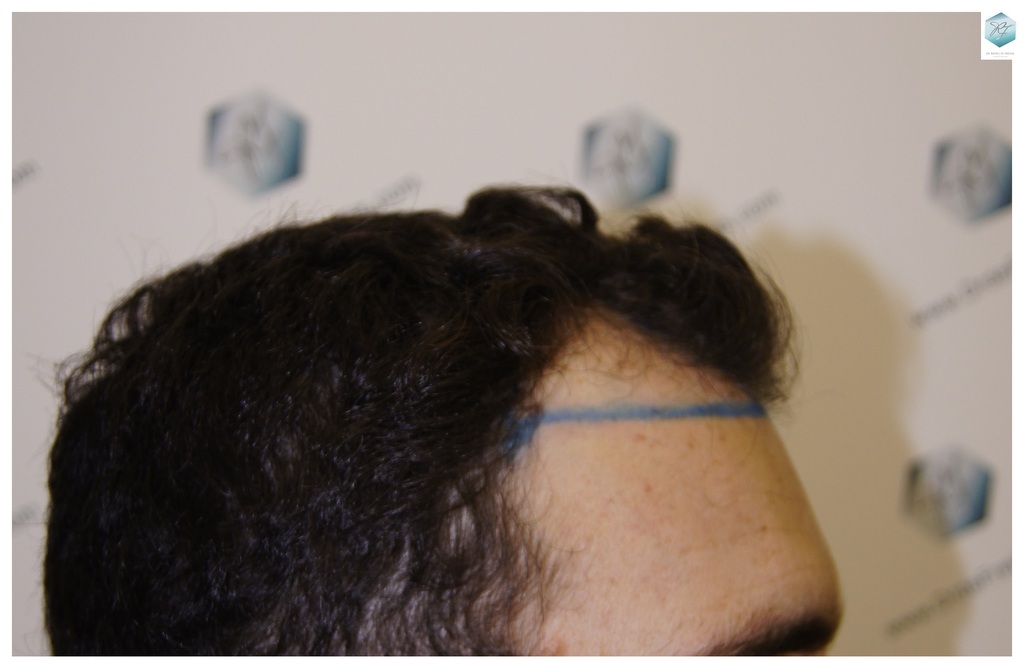 CLINICA DE FREITAS - 2094 GRAFTS FUE 9_zpsb04ggakj