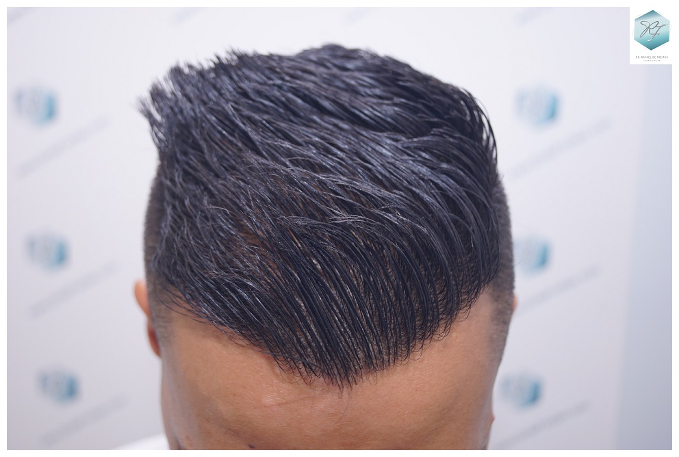 CLINICA DE FREITAS - 2120 GRAFTS FUE 31-EN%2012%20MESES_zpspabpgsca