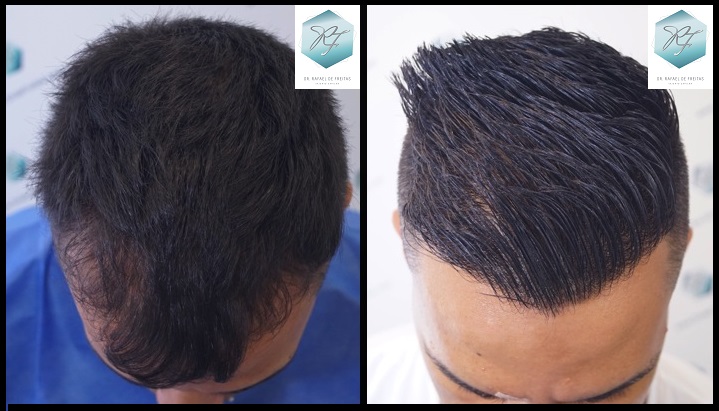 CLINICA DE FREITAS - 2120 GRAFTS FUE Fondo%20negro%20copia%204_zps8wm2fhxi