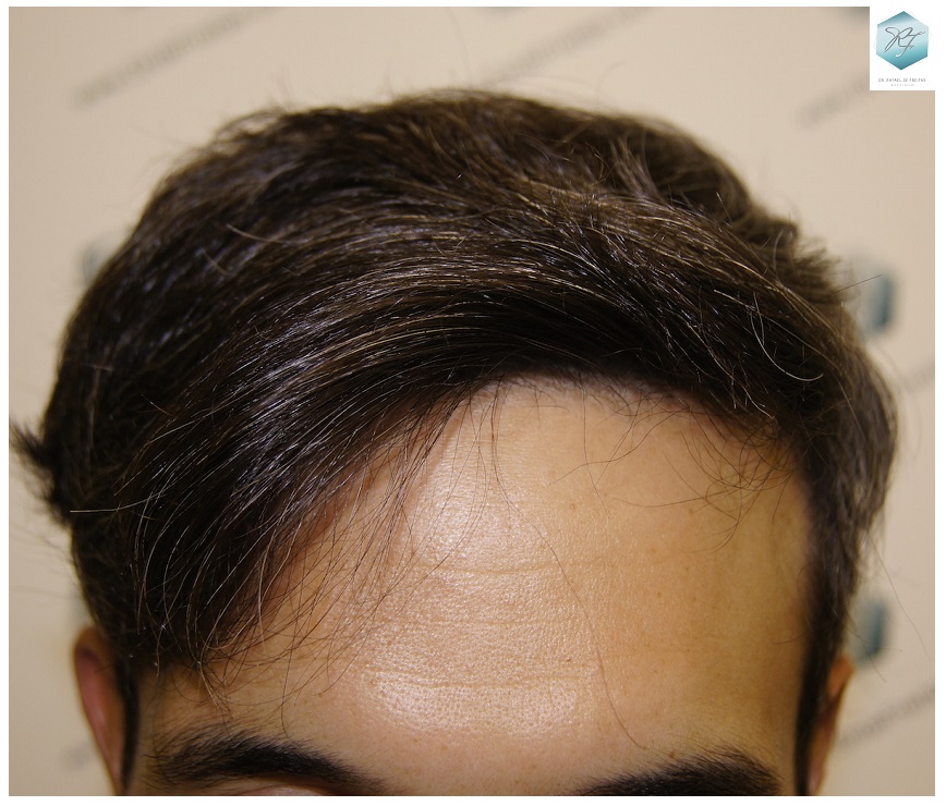 CLINICA DE FREITAS - 2409 GRAFTS FUE 1.1-1year_zpszyinvl9g