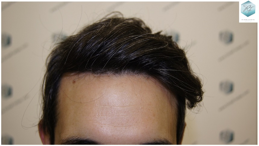 CLINICA DE FREITAS - 2409 GRAFTS FUE 1.2-1year_zpstbnfuulg