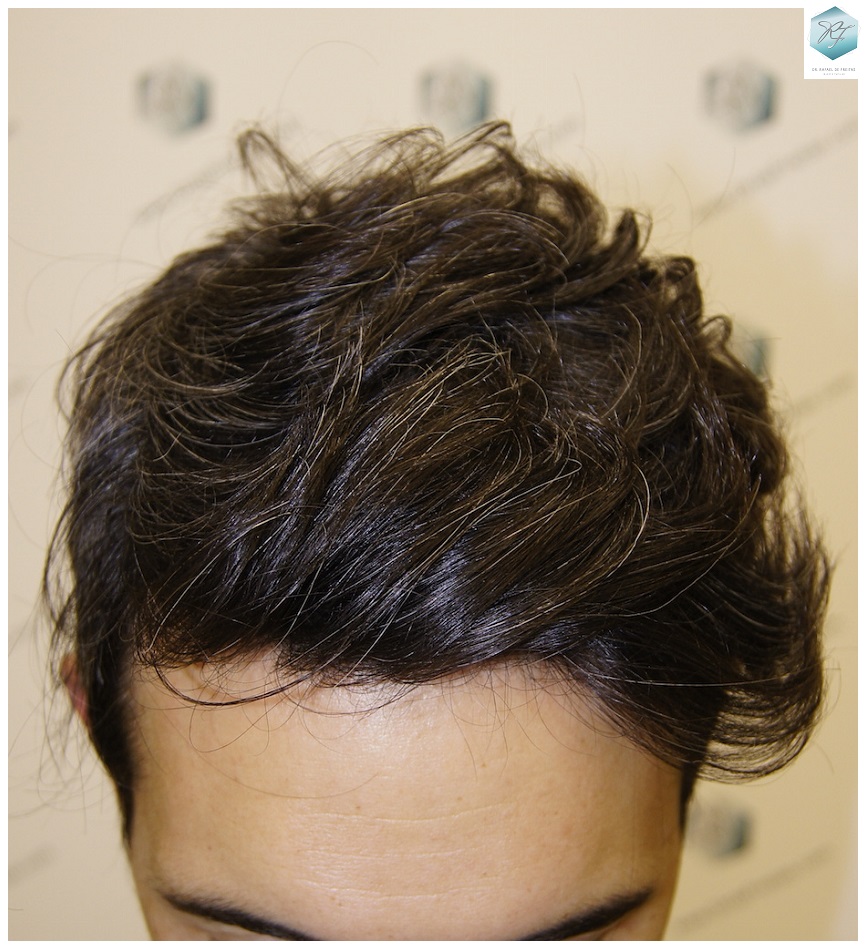 CLINICA DE FREITAS - 2409 GRAFTS FUE 1.3-1year_zpsaywh45hi