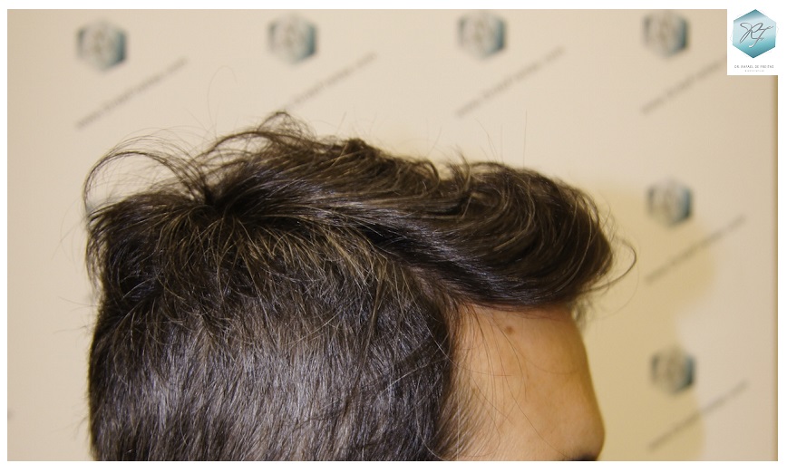 CLINICA DE FREITAS - 2409 GRAFTS FUE 1.5-1year_zpsu2hiqnfq