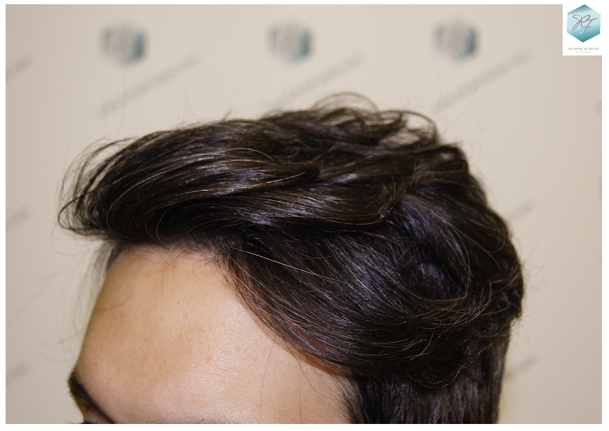 CLINICA DE FREITAS - 2409 GRAFTS FUE 1.7-1year_zpsjhgzvsmr