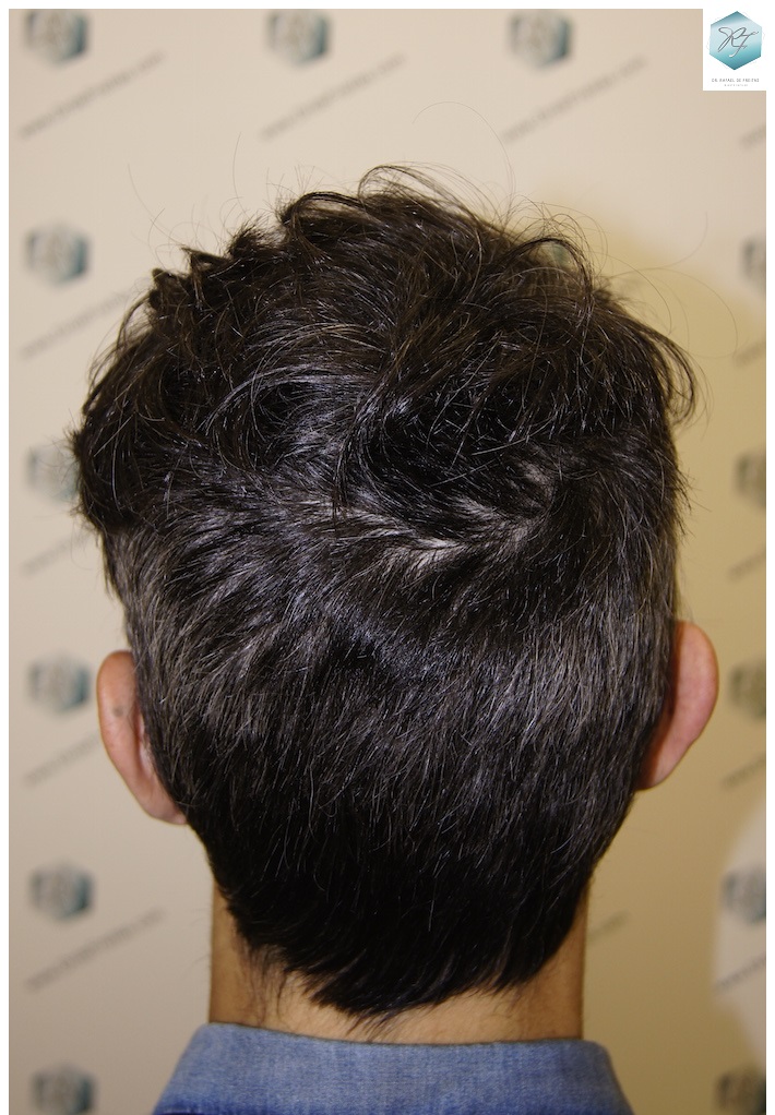 CLINICA DE FREITAS - 2409 GRAFTS FUE 1.8-1year_zpsltsq8xkk