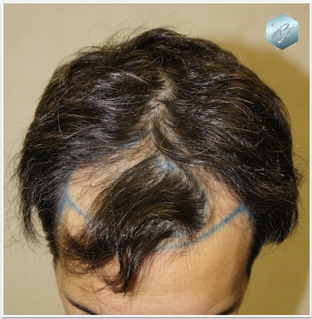 CLINICA DE FREITAS - 2409 GRAFTS FUE 10_zpsdfd526b6