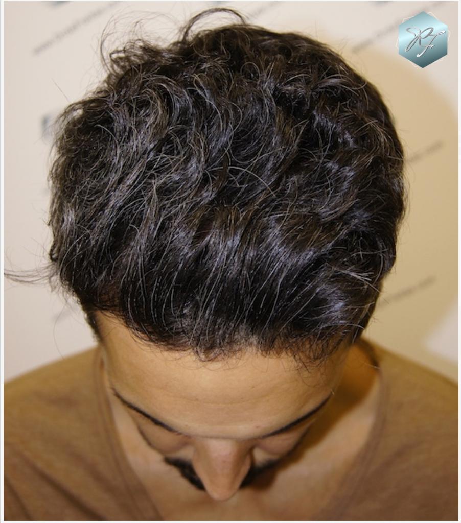 CLINICA DE FREITAS - 2409 GRAFTS FUE 2_zps4e8971f6