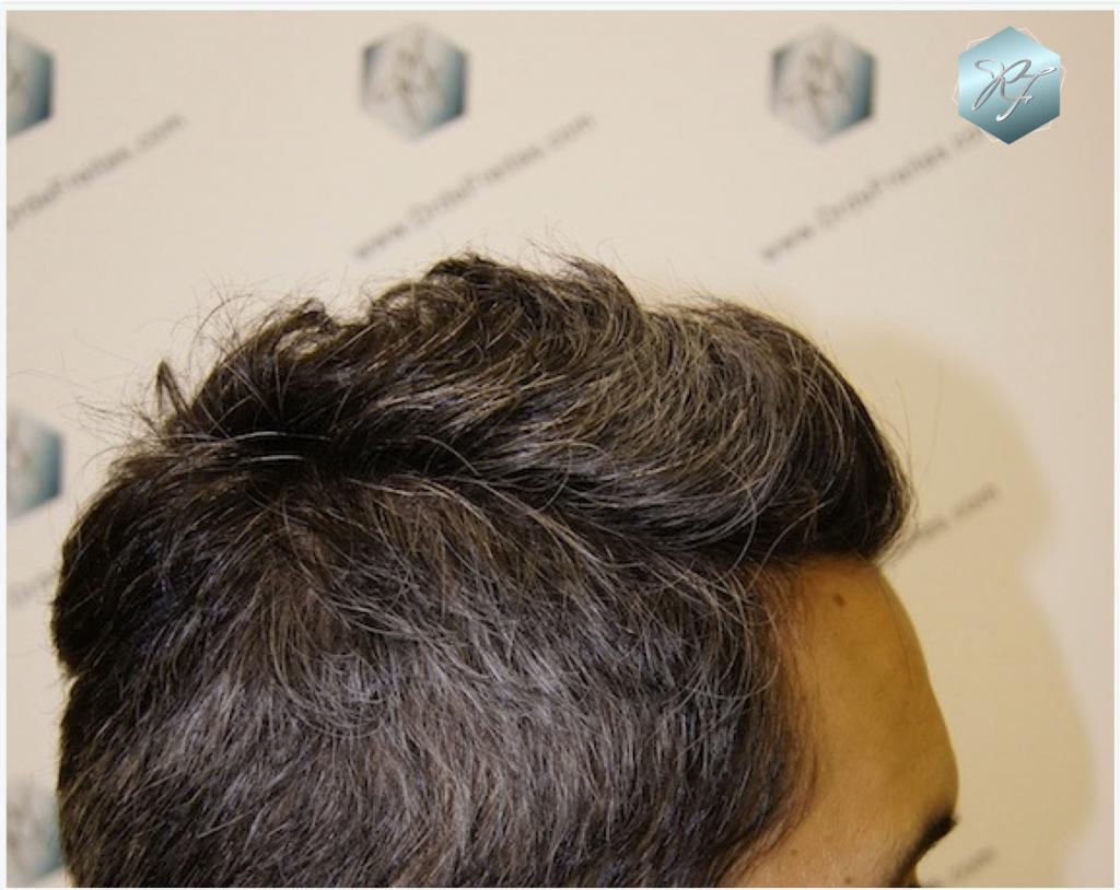 CLINICA DE FREITAS - 2409 GRAFTS FUE 3_zps1ddf9e91