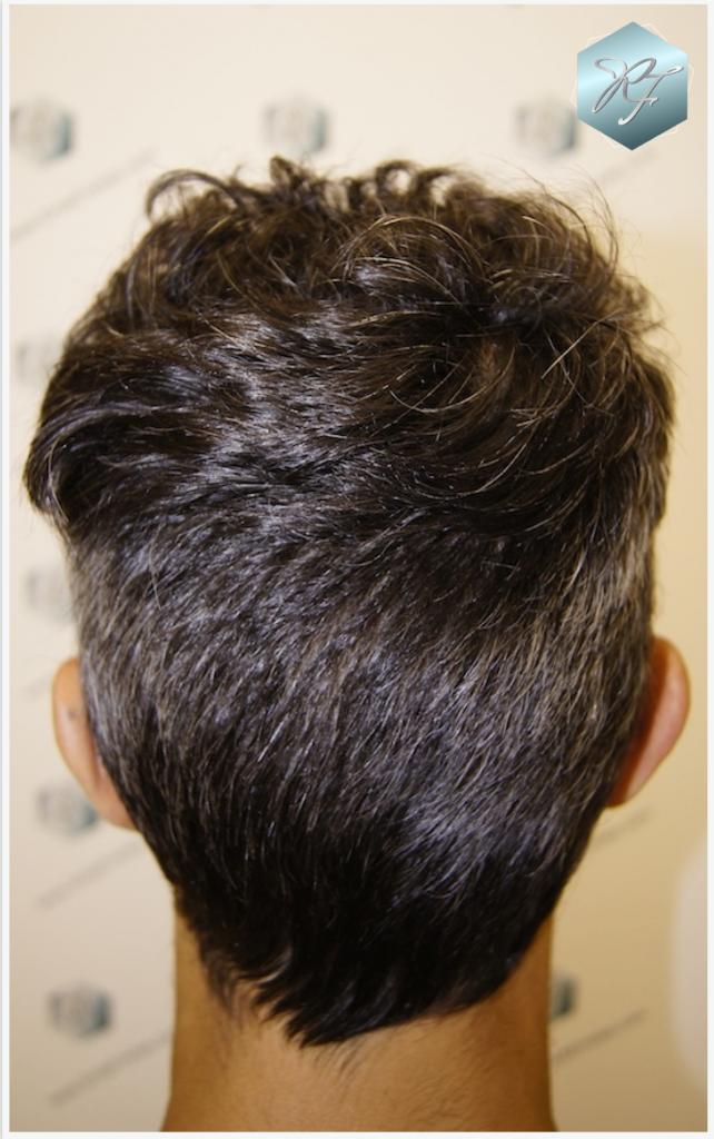 CLINICA DE FREITAS - 2409 GRAFTS FUE 4_zps6ef1a396