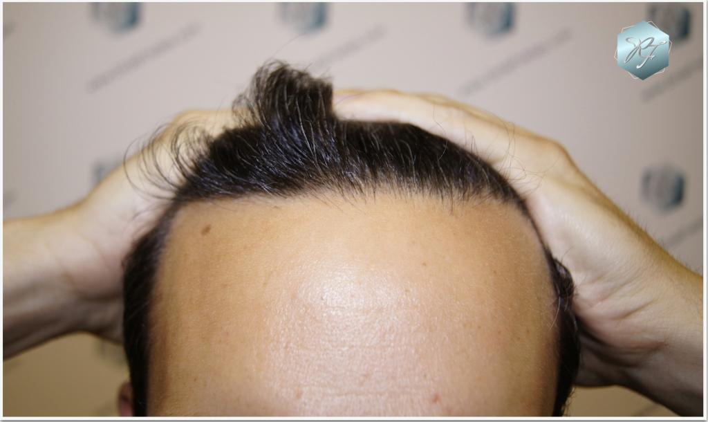 CLINICA DE FREITAS - 2409 GRAFTS FUE 5_zpsc259cfe2