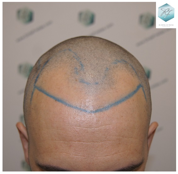 CLINICA DE FREITAS - 2762 GRAFTS FUE 11_zpsyffwd2hq